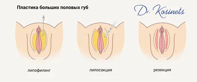 ФОРМА ПОЛОВЫХ ГУБ У женщин... - Клиника интимной пластики | Facebook