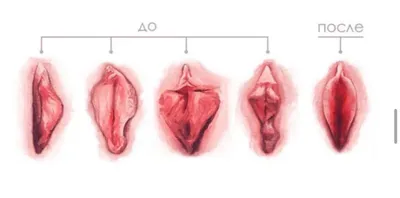 Лабиопластика. Пластика малых и больших половых губ