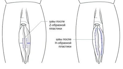 Сальные железы на половых губах у женщин - YouTube