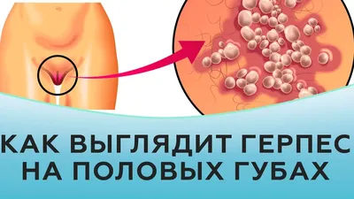 Рак вульвы: симптомы, диагностика, лечение, стадии и профилактика онкологии половых  губ