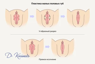 Пластика половых губ (лабиопластика) в Минске - цена уменьшения малых половых  губ