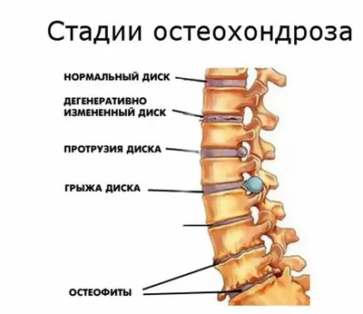 Остеохондроз грудного отдела позвоночника - Стержень