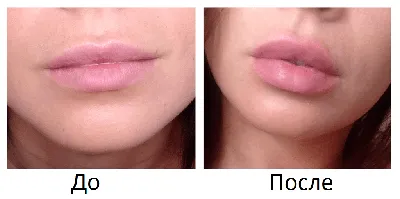 [83+] Увеличение губ картинки обои