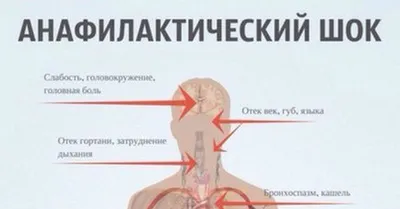 Как распознать анафилактический шок и спасти жизнь человека - Лайфхакер