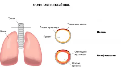 Анафилактический шок