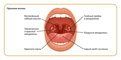 AnnaMama - Про ангину Воспаление небных миндалин и слизистой глотки:  тонзиллит (ангина), фарингит-основная причина боли в горле. Возбудители  ангины-бактерии, вирусы, грибы и др. 1️. Наиболее частые  возбудители-вирусы: антибиотики не нужны проходит ...