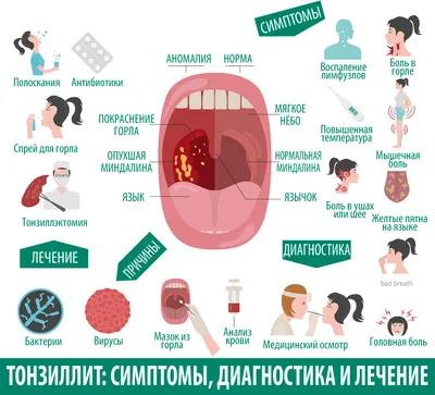 Гнойная ангина: причины, симптомы, заразна ли, осложнения, что делать при  остром тонзиллите