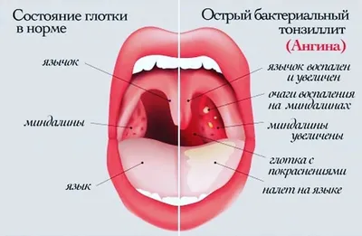 Ангина – причины, симптомы, диагностика и способы лечения заболевания |  Клиника Будь Здоров