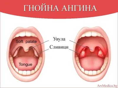 Для тех, кто умудрился заболеть или как победить Ангину | Пикабу