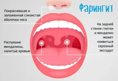 Ангина, тонзиллит, фарингит. Есть ли разница? | Алло, доктор! | Дзен