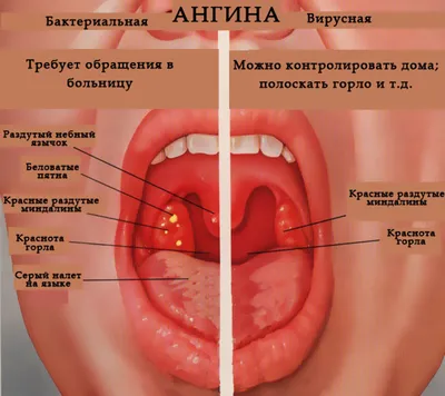 Ангина: причины, и симптомы, лечение, диагностика и профилактика ангины