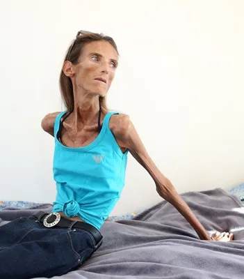 Шокирующие фото 25-килограммовой женщины-анорексички (ФОТО)