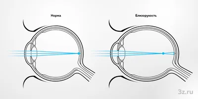 Близорукость картинки
