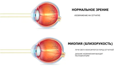 Миопия (Близорукость): причины, симптомы, лечение.