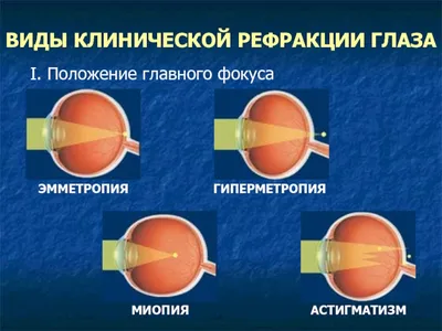 Близорукость. Что это и как она возникает?