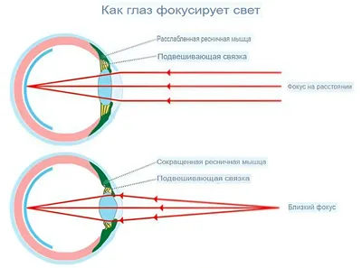 Осложненная миопия: почему нельзя игнорировать близорукость