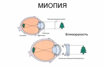 Миопия (близорукость) | Что это такое, степени, лечение и симптомы