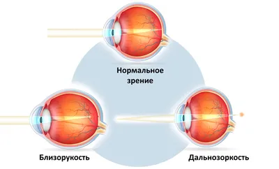 Близорукость: вопросы и ответы