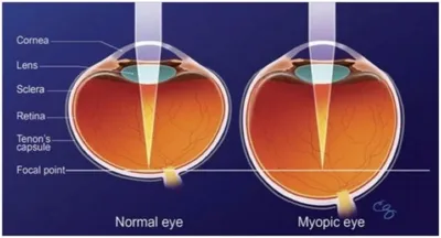 Как вылечить близорукость? - диагностика, лечение и коррекция