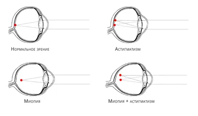 Близорукость и дальнозоркость ‒ в чем разница, где минус, а где плюс,  причины, всё простыми словами