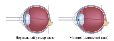 Близорукость (миопия): что это такое | Люксоптика