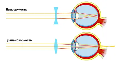 Особенности лечения близорукости, дальнозоркости и астигматизма | World  Vision Clinic