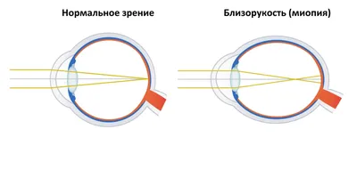 Откуда берётся миопия и как её лечить - Лайфхакер