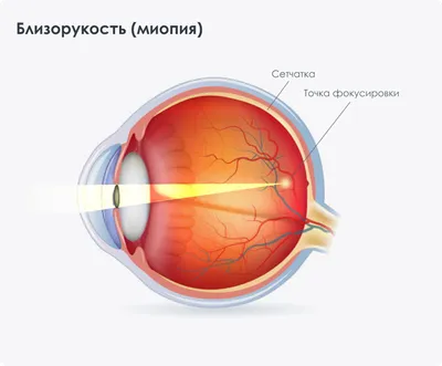 Близорукость – это минус или плюс? — Медицинский центр «Целитель»