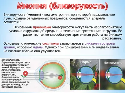 Офтальмологическая клиника «Прозрение»: Близорукость