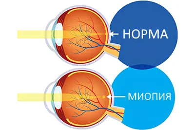 Близорукость . Что мы лечим. МНТК \"Микрохирургия глаза\"