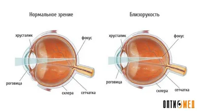 Близорукость более 6 диоптрий - энциклопедия Ochkov.net