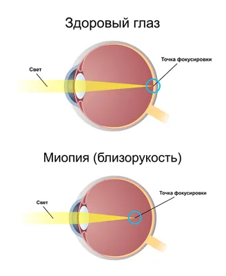 Лечение близорукости у детей