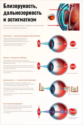 Дальнозоркость или близорукость: различия, сходства, способы лечения и  профилактика