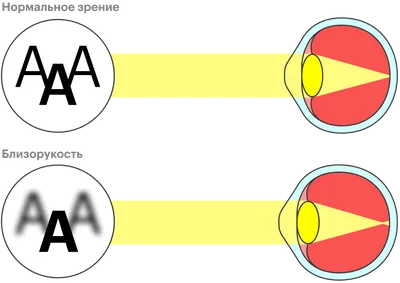 Австралийские ученые: близорукость быстрее прогрессирует при нагрузке на  глаза