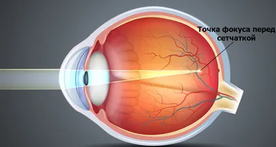 Высокая миопия или близорукость. Симптомы и лечение | ICR