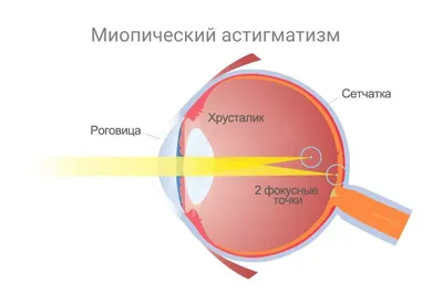 АСТИГМАТИЗМ и БЛИЗОРУКОСТЬ - отличие, разница между болезнями