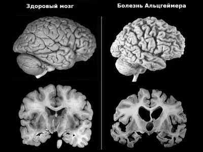 Болезнь альцгеймера картинки