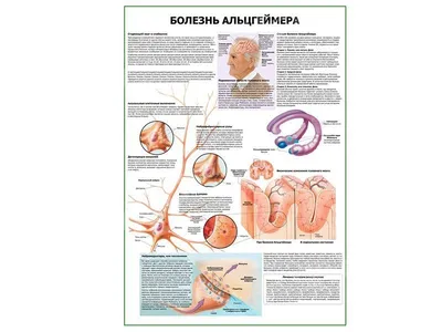 Болезнь Альцгеймера и расстройства сна