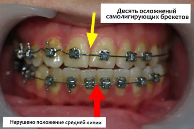 Брекеты на верхнюю челюсть в Омске, цены на установку в стоматологии  «Ортодонт-центр»