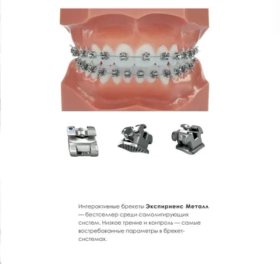 Брекеты в Москве под ключ недорого, установка брекетов, цены от ДантистоФФ
