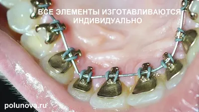 Брекеты в Курске: установка брекетов в стоматологии Doctor Smile