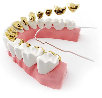 Поставить брекеты в Омске по доступным ценам - стоматология \"Жемчужный слон\"