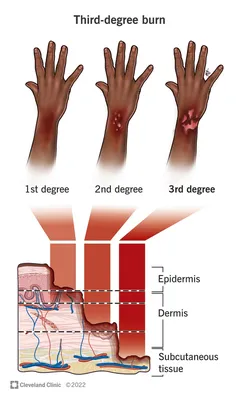 Burn Pictures: First, Second, and Third Degree