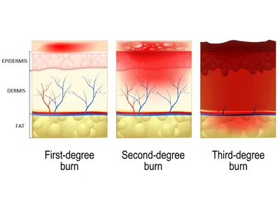 Third degree burn skin hi-res stock photography and images - Alamy