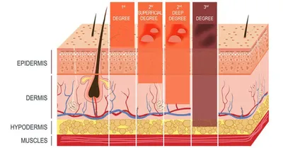 First-degree burn: Treatment, symptoms, and pictures