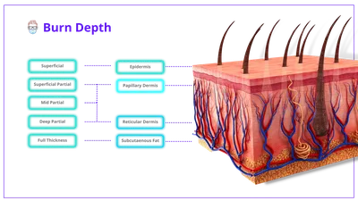 Identifying a Severe Burn - Elite Hospital Kingwood