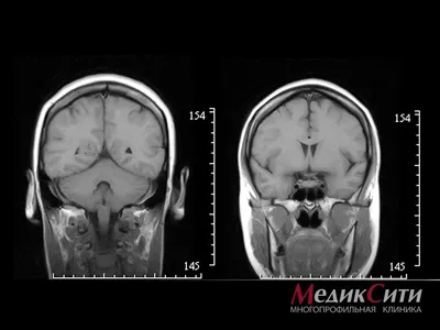 Черепно-мозговые травмы, сотрясение мозга, ушиб мозга. Симптомы,  последствия и лечение.