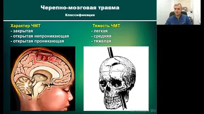 Лекция по черепно-мозговой травме. Нейрохирург Ошурков Павел Александрович,  г. Екатеринбург. - YouTube