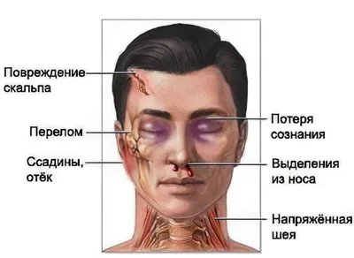 Энциклопедия - Черепно-мозговые травмы