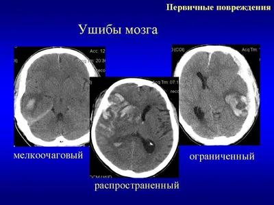 Черепно-мозговая травма и эпилепсия